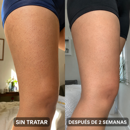 BerrySkin®: Eliminá tu Piel de Frutilla